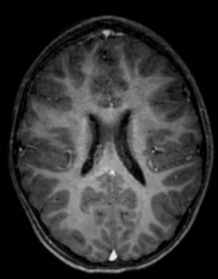 Cerebellar abscess (Radiopaedia 73727-84563 Axial T1 C+ fat sat 73).jpg