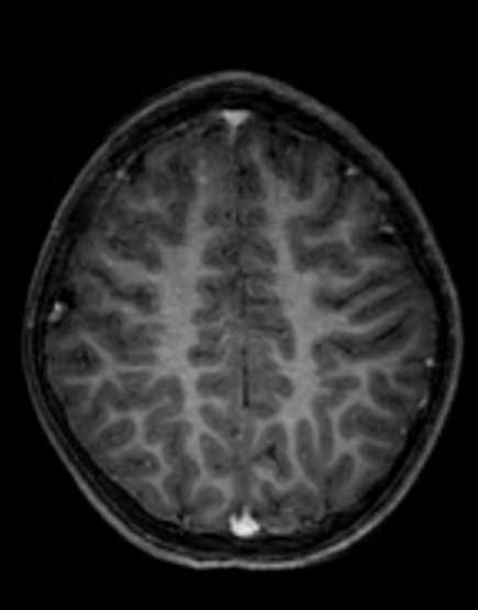 Cerebellar abscess (Radiopaedia 73727-84563 Axial T1 C+ fat sat 84).jpg