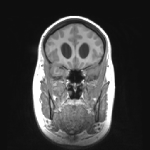 Cerebellar ependymoma complicated by post-operative subdural hematoma (Radiopaedia 83322-97736 Coronal T1 17).png