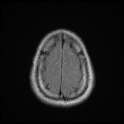 File:Cerebellar hemangioblastoma (Radiopaedia 88055-104622 Axial FLAIR 22).jpg
