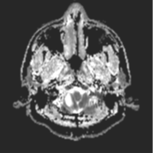File:Cerebellar hemangioblastomas and pituitary adenoma (Radiopaedia 85490-101176 Axial ADC 3).png