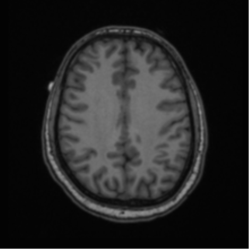 Cerebellar hemangioblastomas and pituitary adenoma (Radiopaedia 85490-101176 Axial T1 50).png