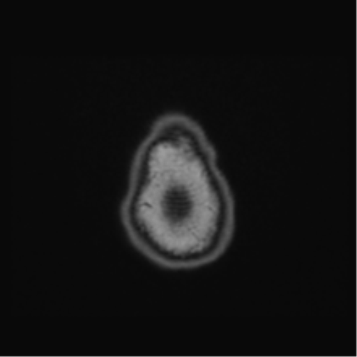Cerebellar hemangioblastomas and pituitary adenoma (Radiopaedia 85490-101176 Axial T1 72).png