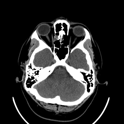 File:Cerebellar infarction (Radiopaedia 16625-16327 Axial non-contrast 10).jpg