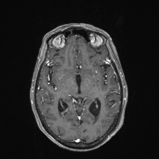 Cerebellar metastases (Radiopaedia 24038-24249 Axial T1 C+ 18).jpg