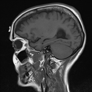 File:Cerebellar metastases (Radiopaedia 24038-24249 Sagittal T1 4).jpg