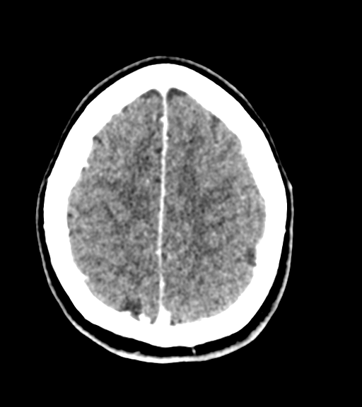 Cerebellar metastases - colorectal adenocarcinoma (Radiopaedia 40947-43652 Axial C+ 52).png