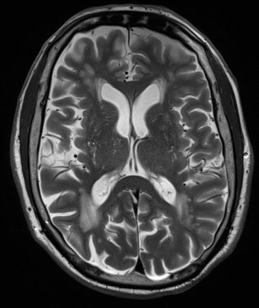 File:Cerebellar metastasis (Radiopaedia 33616-34718 Axial T2 22).png