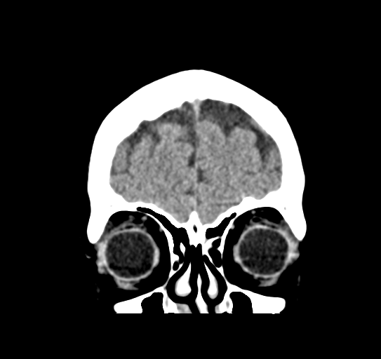 Cerebellar metastasis (Radiopaedia 54578-60812 Coronal non-contrast 7).png