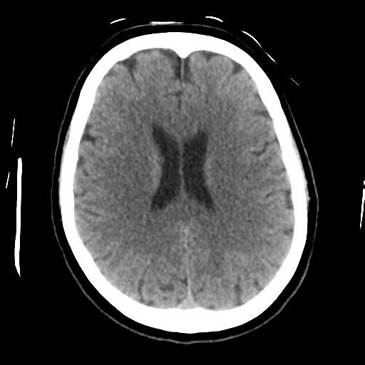 Cerebellar metastasis (cystic appearance) (Radiopaedia 41395-44258 Axial non-contrast 34).png