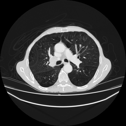 File:Cerebellar metastasis - lung tumor (Radiopaedia 69317-79150 Axial lung window 15).jpg