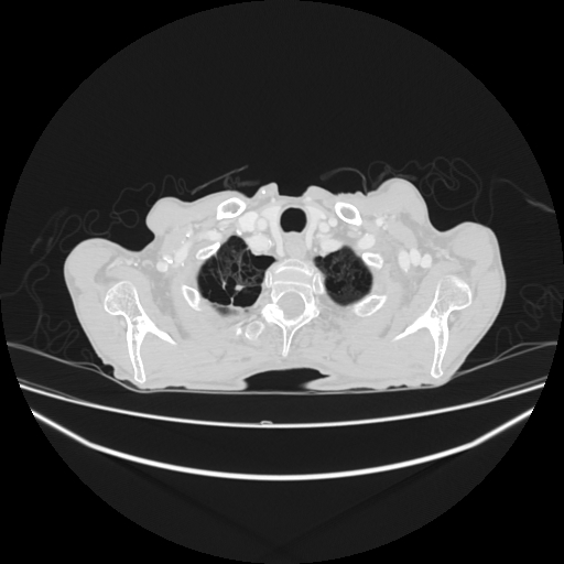 File:Cerebellar metastasis - lung tumor (Radiopaedia 69317-79150 Axial lung window 2).jpg