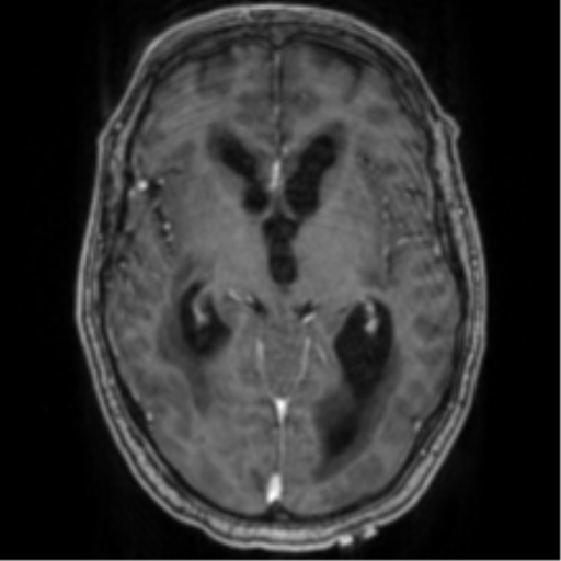 Cerebellar metastasis from lung adenocarcinoma (Radiopaedia 86690-102829 Axial T1 C+ 39).png