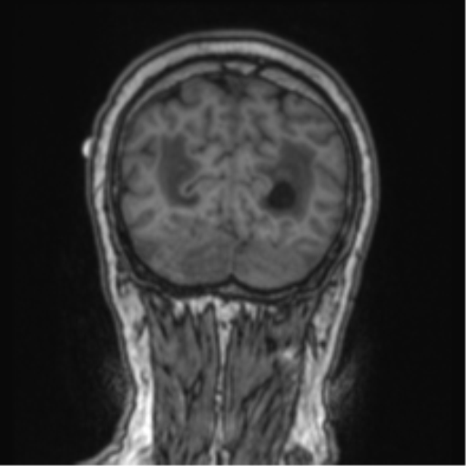 Cerebellar metastasis from lung adenocarcinoma (Radiopaedia 86690-102829 Coronal T1 19).png