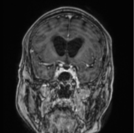 Cerebellar metastasis from lung adenocarcinoma (Radiopaedia 86690-102829 Coronal T1 C+ 63).png