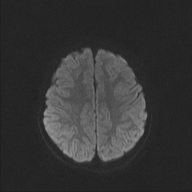 File:Cerebellar stroke (Radiopaedia 32202-33150 Axial DWI 39).png