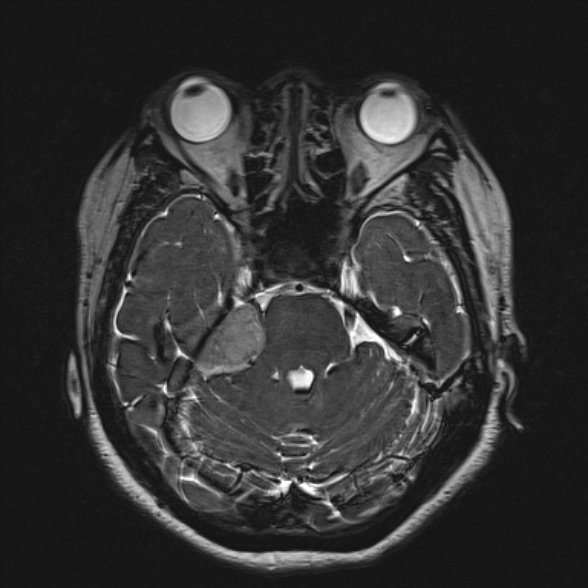 Cerebellopontine angle meningioma (Radiopaedia 53561-59591 Axial 3D volume T2 73).jpg