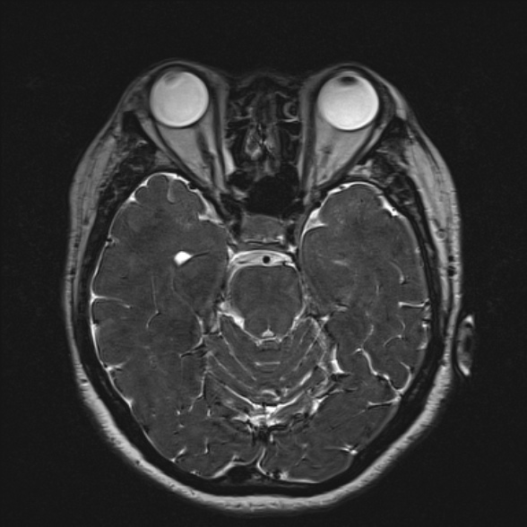 Cerebellopontine angle meningioma (Radiopaedia 53561-59591 Axial 3D volume T2 86).jpg