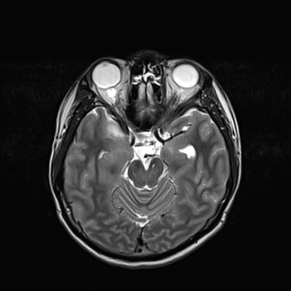 Cerebral abscess (Radiopaedia 24212-24478 Axial T2 25).jpg