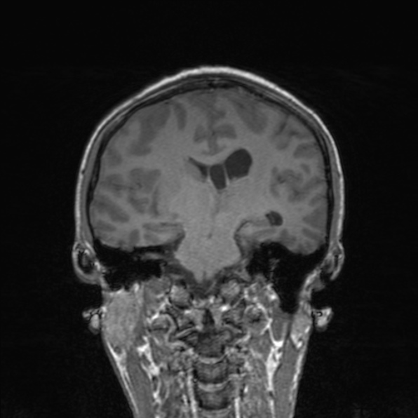Cerebral abscess (Radiopaedia 24212-24478 Coronal T1 120).jpg