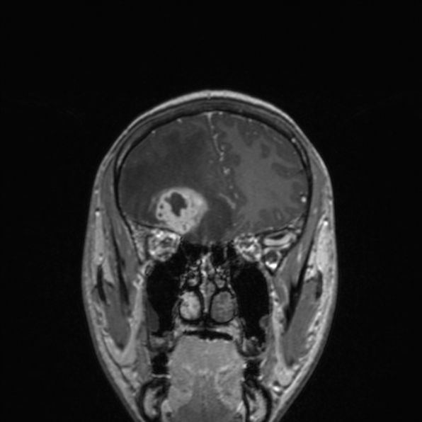 Cerebral abscess (Radiopaedia 24212-24478 Coronal T1 C+ 66).jpg