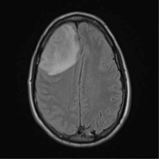 File:Cerebral abscess (Radiopaedia 60342-68009 Axial FLAIR 21).png