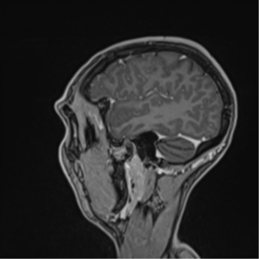 Cerebral abscess (Radiopaedia 60342-68009 J 14).png