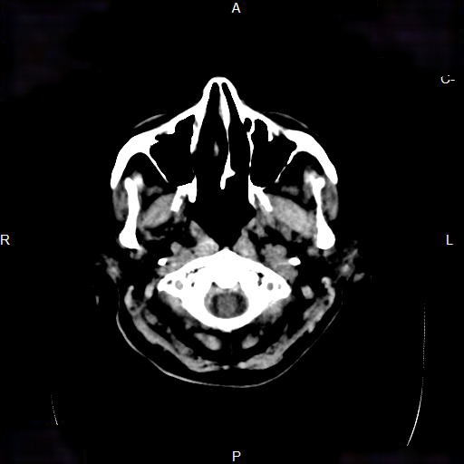 File:Cerebral abscess (Radiopaedia 7606-8431 Axial non-contrast 5).jpg
