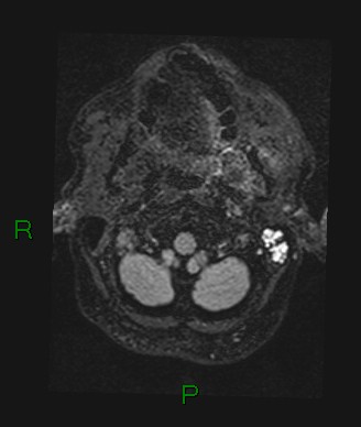 File:Cerebral abscess and subdural empyema (Radiopaedia 84436-99779 Axial FLAIR 78).jpg