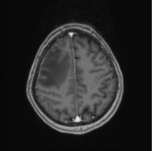 Cerebral abscess from pulmonary arteriovenous malformation (Radiopaedia 86275-102291 Axial T1 C+ 58).png