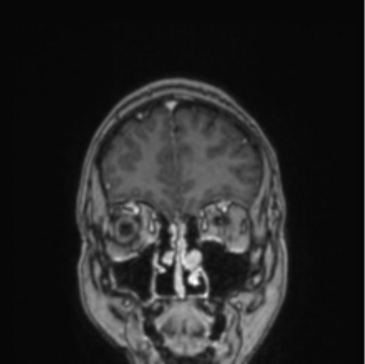 Cerebral abscess from pulmonary arteriovenous malformation (Radiopaedia 86275-102291 L 73).png