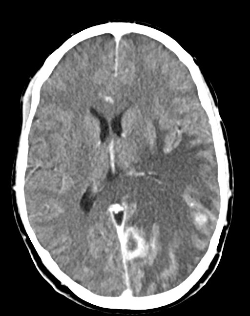 Cerebral abscesses (Radiopaedia 70458-80568 Axial Contrast 35).jpg