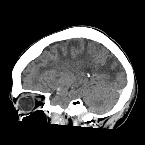 Cerebral amyloid angiopathy-related inflammation (Radiopaedia 74836-85848 C 41).jpg