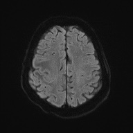 Cerebral amyloid angiopathy-related inflammation (Radiopaedia 74836-85849 Axial DWI 52).jpg