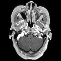 Cerebral amyloid angiopathy (Radiopaedia 29129-29518 Axial T1 C+ 28).jpg