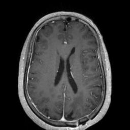 Cerebral amyloid angiopathy (Radiopaedia 29129-29518 Axial T1 C+ 92).jpg
