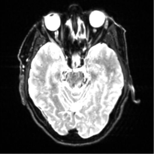 File:Cerebral amyloid angiopathy (Radiopaedia 46082-50433 Axial DWI 9).png