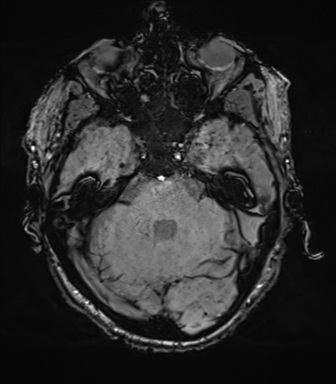 File:Cerebral amyloid angiopathy (Radiopaedia 46082-50433 Axial SWI 22).png