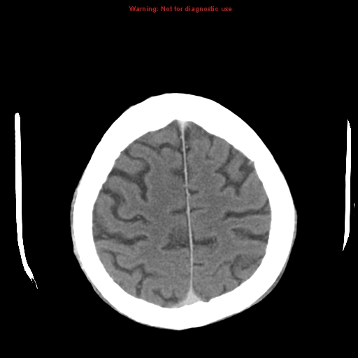 File:Cerebral and orbital tuberculomas (Radiopaedia 13308-13310 B 24).jpg