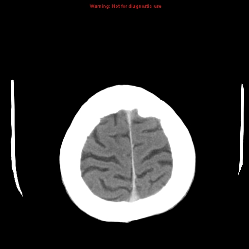 File:Cerebral and orbital tuberculomas (Radiopaedia 13308-13310 B 26).jpg