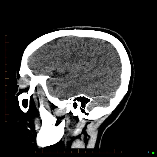 File:Cerebral arteriovenous malformation (AVM) (Radiopaedia 78162-90706 A 61).jpg