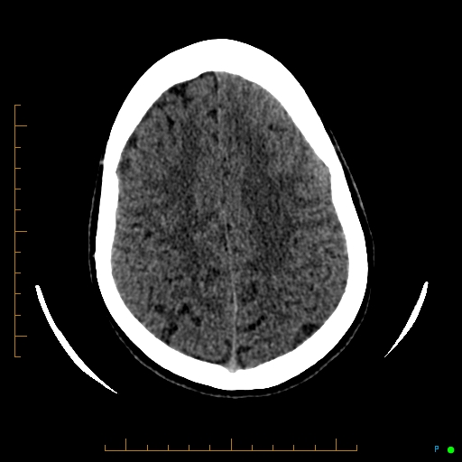 Cerebral arteriovenous malformation (AVM) (Radiopaedia 78162-90706 Axial non-contrast 49).jpg