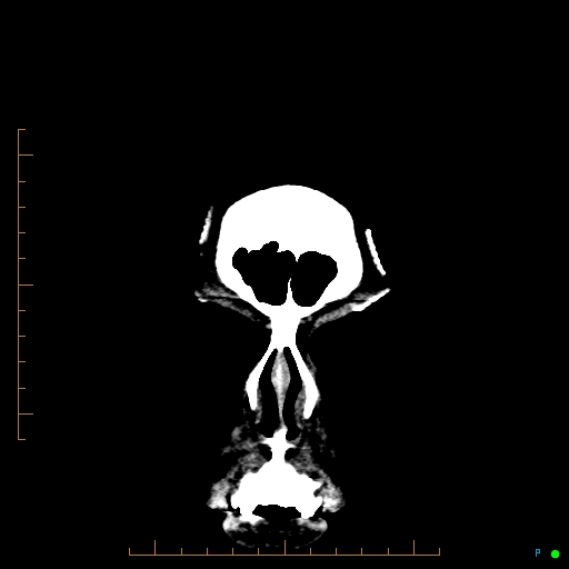 Cerebral arteriovenous malformation (AVM) (Radiopaedia 78162-90706 Coronal non-contrast 8).jpg