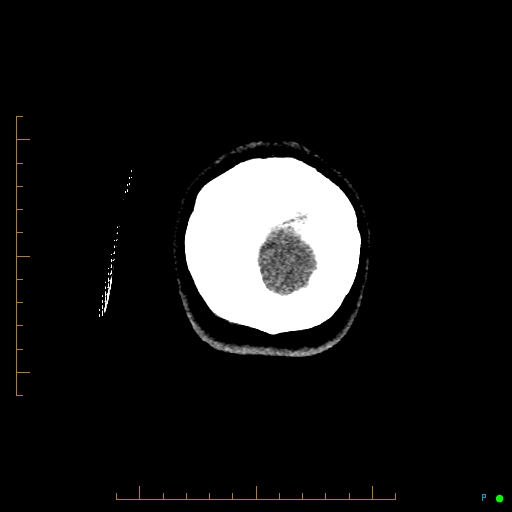 Cerebral arteriovenous malformation (AVM) (Radiopaedia 78162-90706 Coronal non-contrast 96).jpg