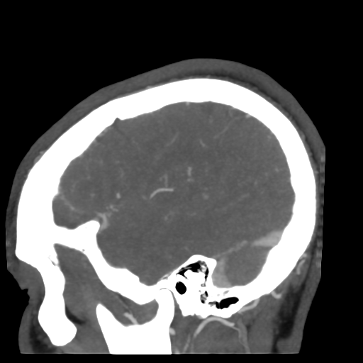 Cerebral arteriovenous malformation (Radiopaedia 39259-41505 Sagittal 50).png