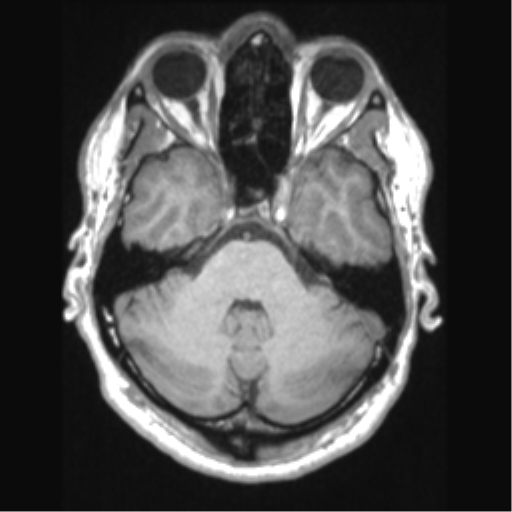 Cerebral arteriovenous malformation (Radiopaedia 39259-41506 Axial T1 22).png