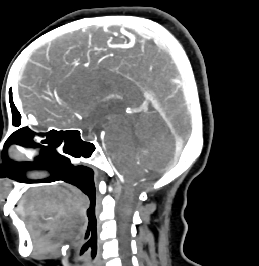 Cerebral arteriovenous malformation (Radiopaedia 73830-84645 D 46).jpg