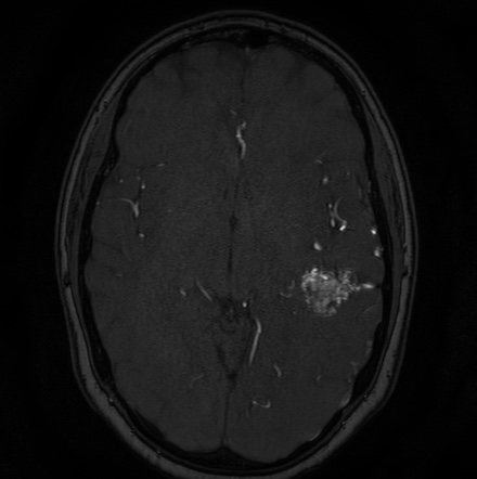 Cerebral arteriovenous malformation (Radiopaedia 74411-85654 Axial MRA 67).jpg