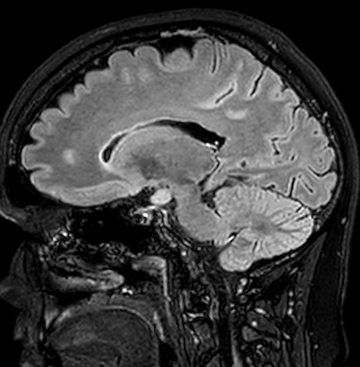 Cerebral arteriovenous malformation (Radiopaedia 74411-85746 Sagittal FLAIR 46).jpg