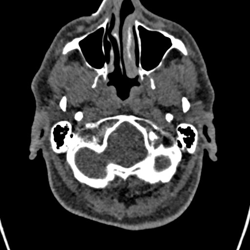 Cerebral arteriovenous malformation (Radiopaedia 78188-90746 Axial non-contrast 17).jpg